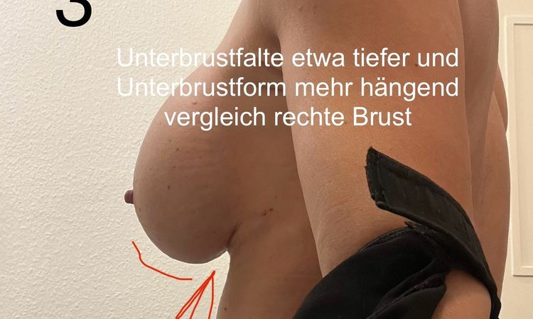 Asymmetrie nach Bruststraffung T-Schnitt mit Implantatwechsel 4 Wochen post-OP - 79321