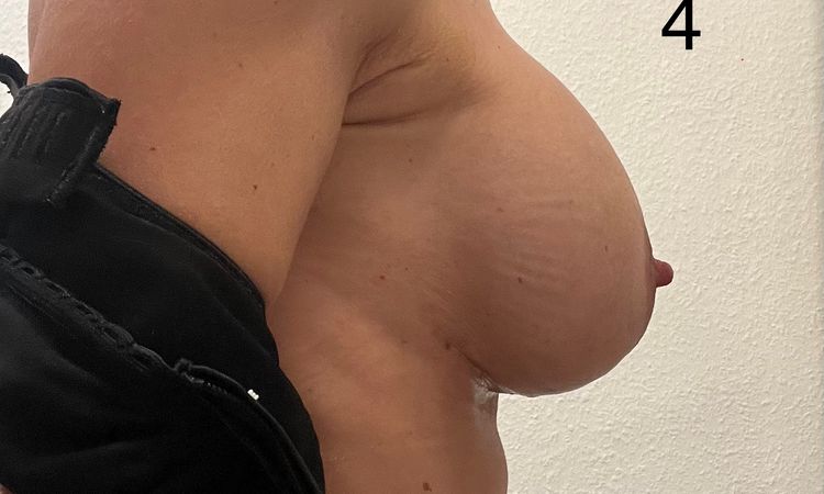 Asymmetrie nach Bruststraffung T-Schnitt mit Implantatwechsel 4 Wochen post-OP - 79322
