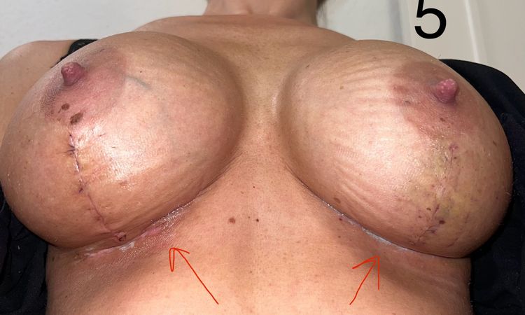 Asymmetrie nach Bruststraffung T-Schnitt mit Implantatwechsel 4 Wochen post-OP - 79323