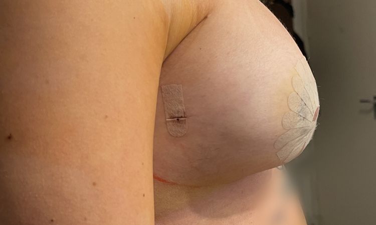 Waterfall Deformity / Snoopy Brust nach Straffung mit Implantat? - 79388