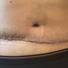 Schiefe Narbe nach Bauchdeckenstraffung und Verhärtung (einseitig)