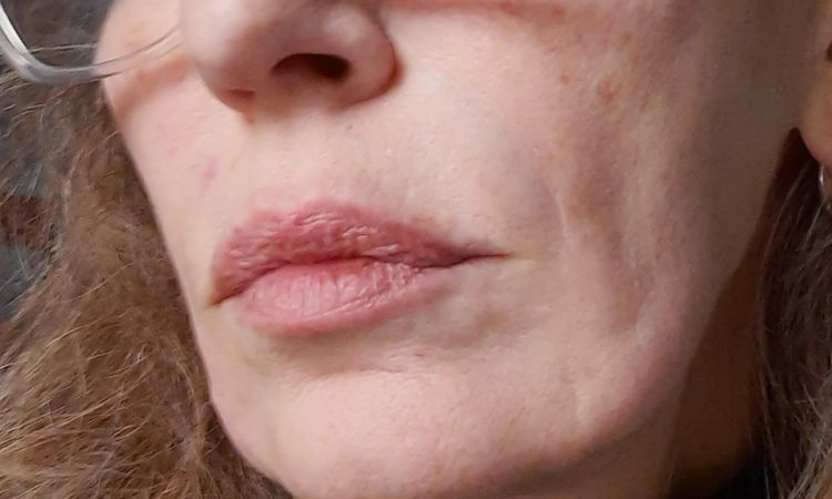 Lipofilling Gesicht, - 79459