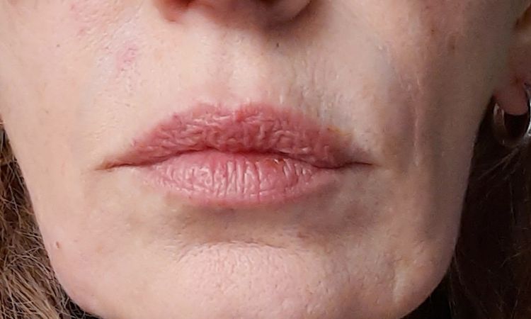 Lipofilling Gesicht, - 79460