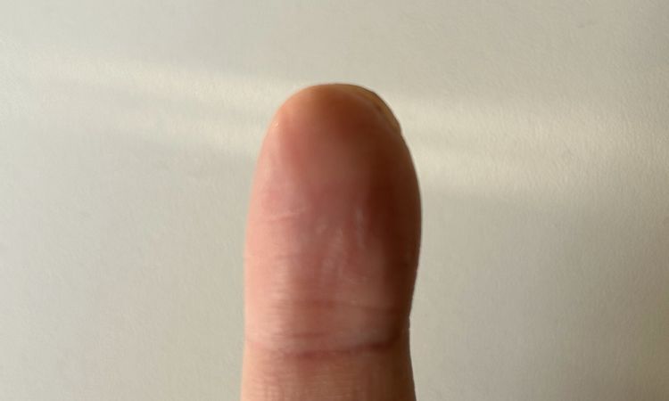 Rekonstruktion Teil der Fingerkuppe - 79462