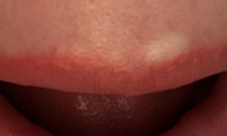 Bleibende knoten nach Hyaluronunterspritzung der Lippen - 79491