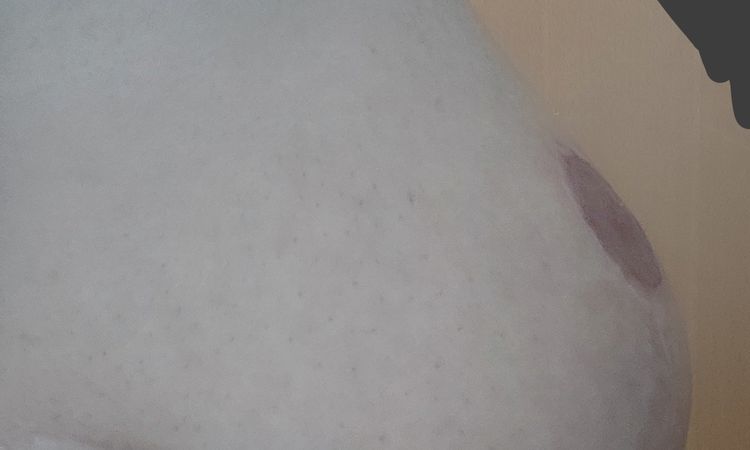 Nach Bruststraffung Brust abgesetzt, Nippel zu weit oben - 79555