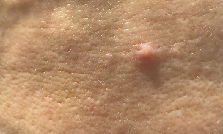Einstichstelle nach Botox entzündet ( 7 Tage vergangenen ) - 79577