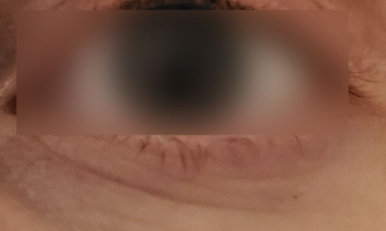 Störende Narbe/Hautfalte nach Ptosis OP - 79607
