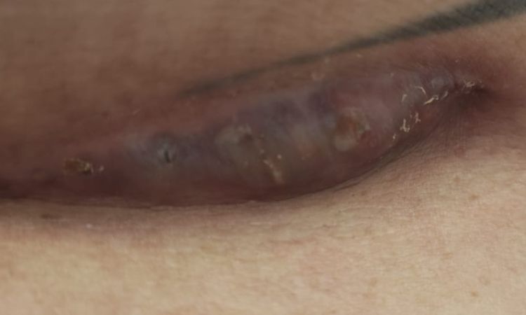 Hilfe implantat verliert wundwasser und ist offen - 79623