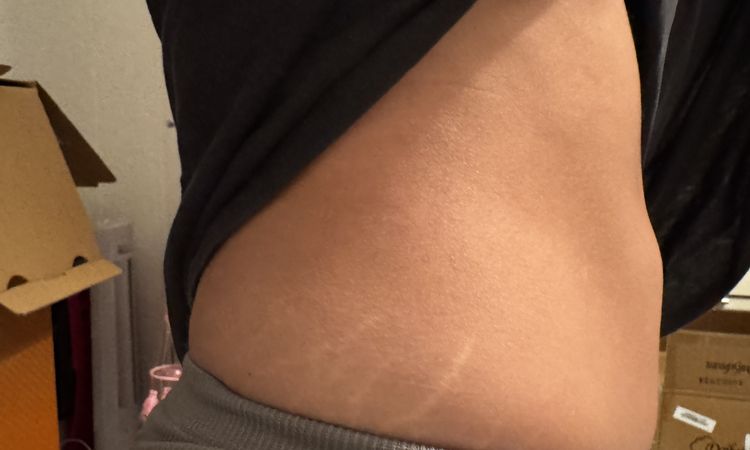 Sitzfalte am Bauch nach 360 Lipo und immernoch Taub am Rücken - 79634