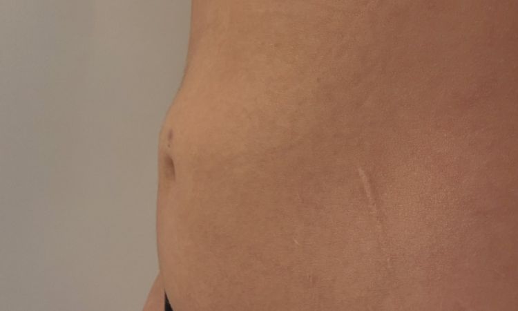 Sitzfalte am Bauch nach 360 Lipo und immernoch Taub am Rücken - 79636
