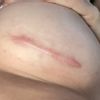 Wulstige/rote Narbe nach Brustvergrößerung