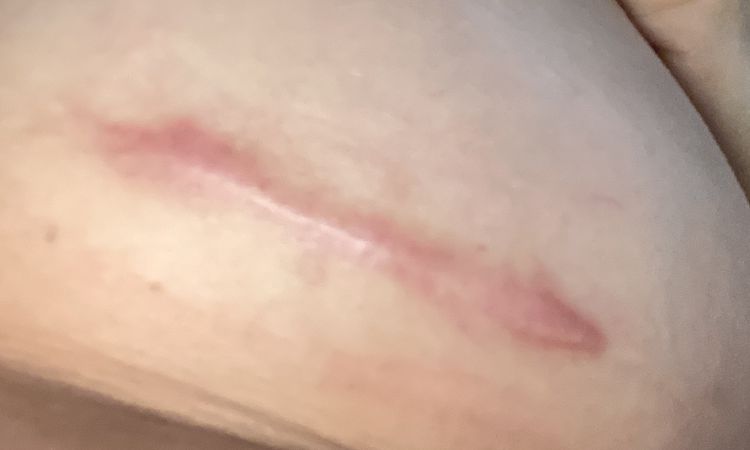 Wulstige/rote Narbe nach Brustvergrößerung - 79691