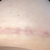 Wulstige/rote Narbe nach Brustvergrößerung
