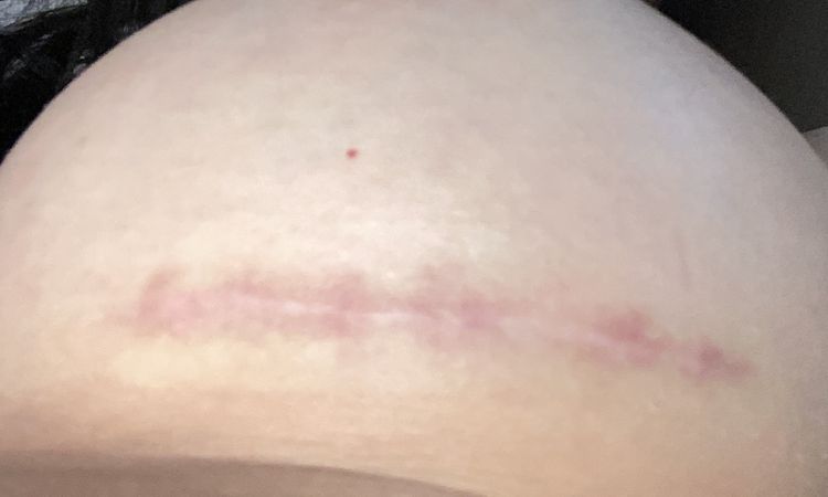 Wulstige/rote Narbe nach Brustvergrößerung - 79692