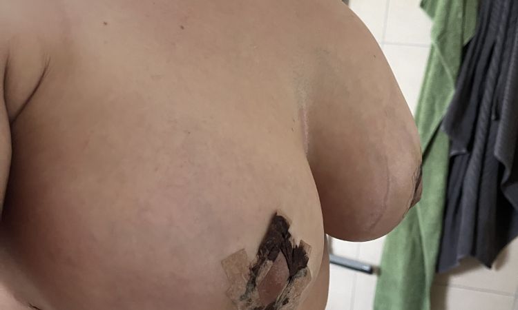 Brustvergrösserung geschwollen - 79713