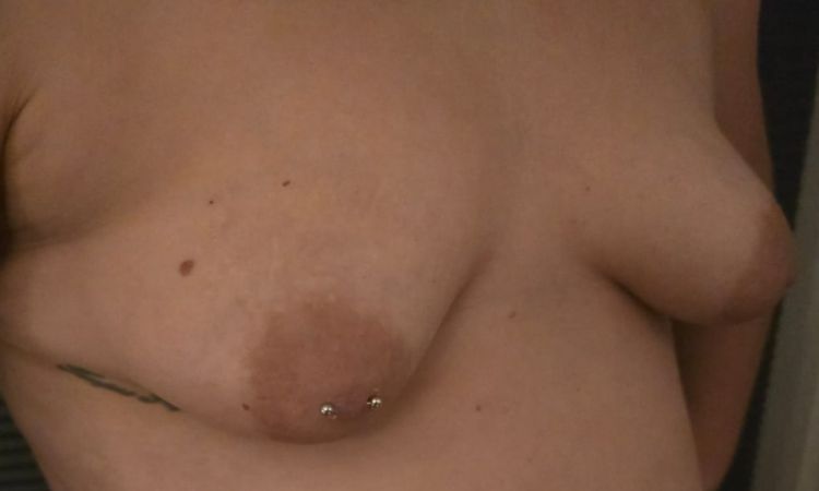 Tubuläre Brust, Kostenübernahme KK - 79760