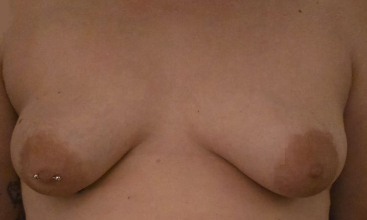 Tubuläre Brust, Kostenübernahme KK - 79764