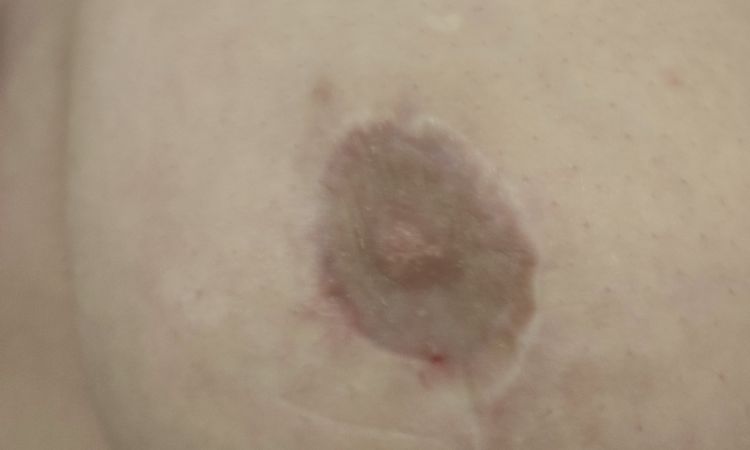 Bruststraffung nicht erfolgreich? - 79768