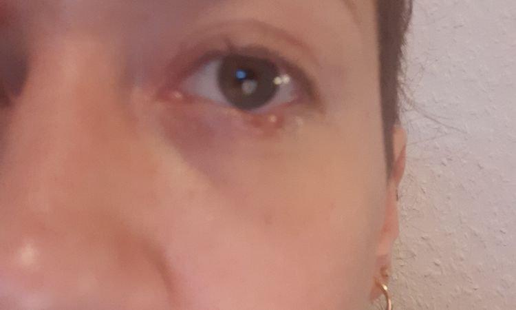 Was tun nach Komplikation am Lidrand nach Tränensackentfernung? - 79825