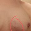 Warum bilden sich 2 Jahre nach OP blaue Flecken ?