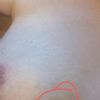 Warum bilden sich 2 Jahre nach OP blaue Flecken ?