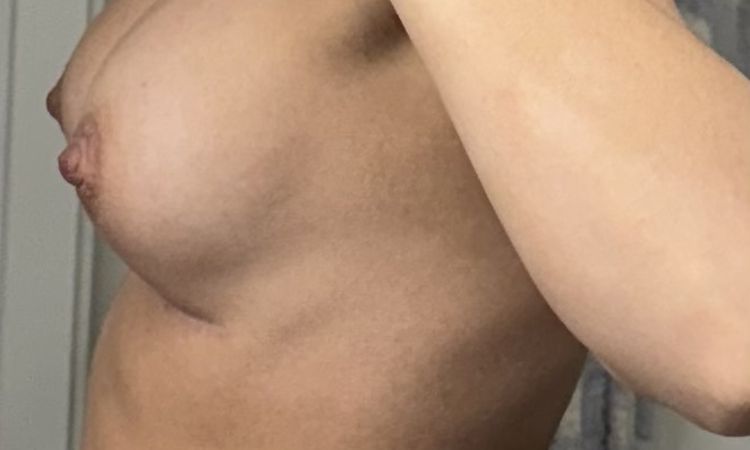 Waterfall Deformity nach Brustvergrößerung? - 79845