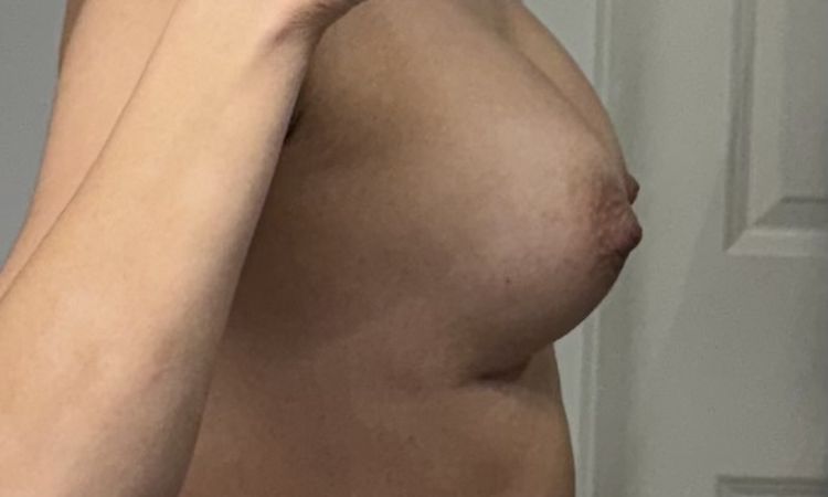 Waterfall Deformity nach Brustvergrößerung? - 79846