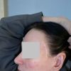 Schlimme Narben nach Facelift