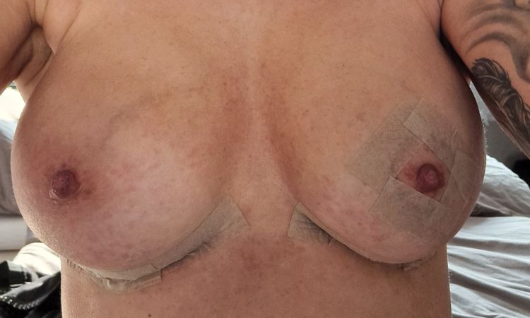 2 wochen nach brust op über den muskel. - 80069
