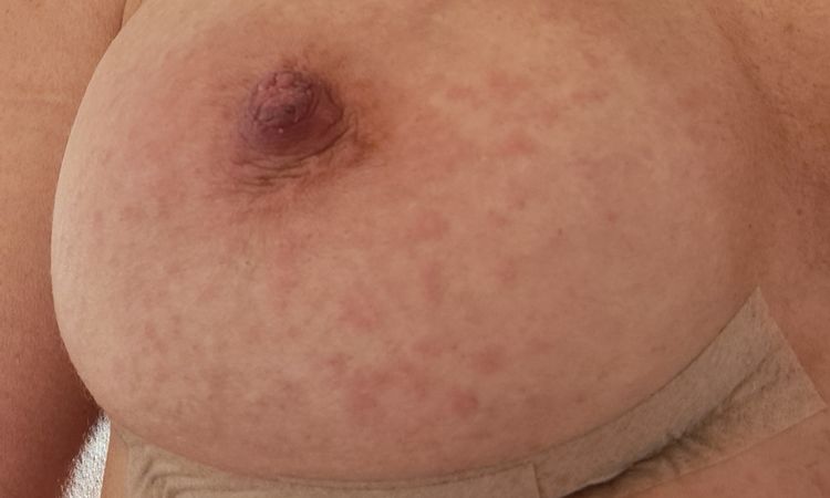 2 wochen nach brust op über den muskel. - 80071