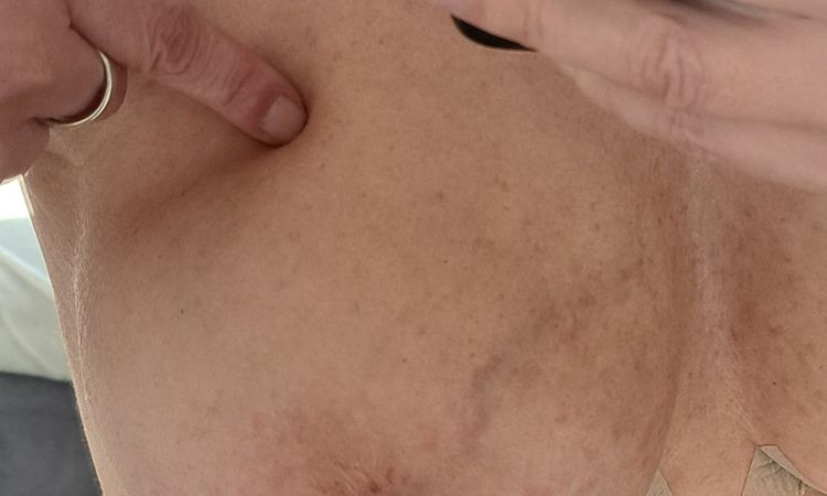 2 wochen nach brust op über den muskel. - 80072