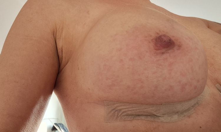 2 wochen nach brust op über den muskel. - 80074