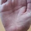 Persistente Schwellung nach Karpaltunnel OP (neurologisch unauffällig)
