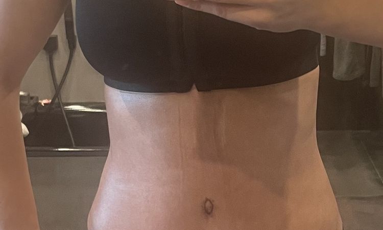 Hernie nach Bauchdeckenstraffung? - 80269
