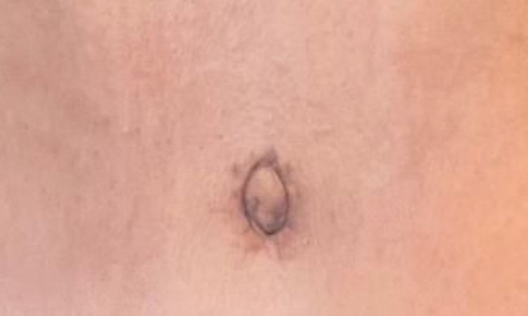 Hernie nach Bauchdeckenstraffung? - 80270