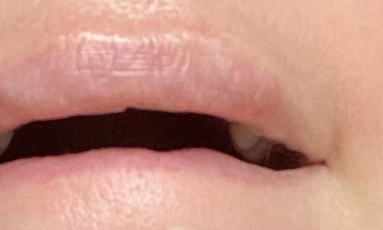 Knubbel und Gewebeschwund nach Hyaluronbehandlung der Lippen - 80323
