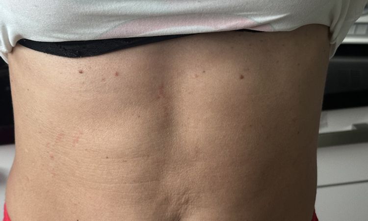 Lipo am Bauch Falten über dem Nabel was tun - 80334