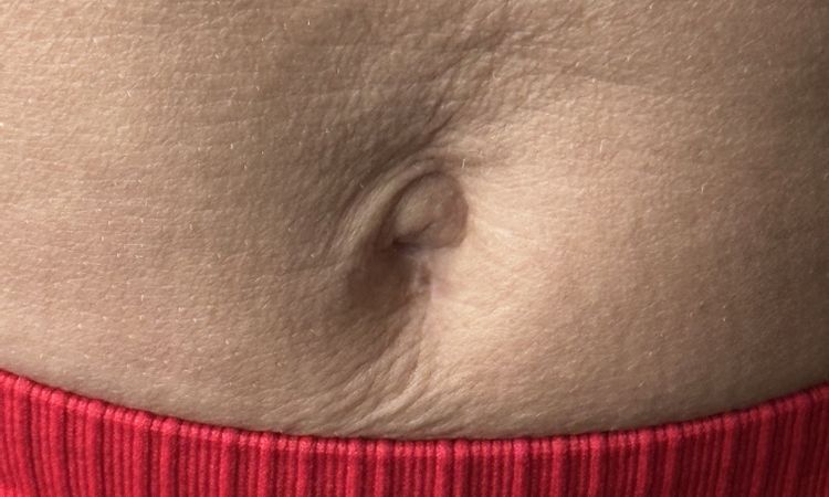 Lipo am Bauch Falten über dem Nabel was tun - 80335