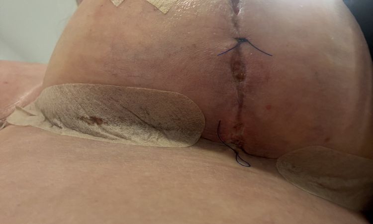 Wundheilungsstörung nach Straffung mit Implantat - 80337