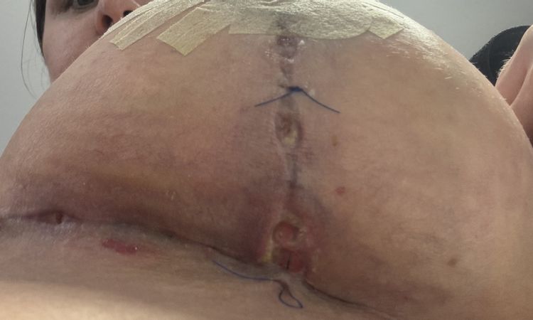 Wundheilungsstörung nach Straffung mit Implantat - 80338