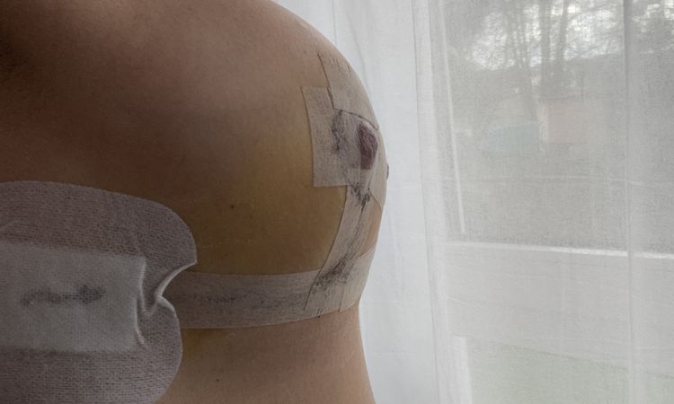 Wie wird sich die Brust nach der Brustverkleinerung entwickeln? - 80352