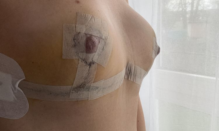 Wie wird sich die Brust nach der Brustverkleinerung entwickeln? - 80353