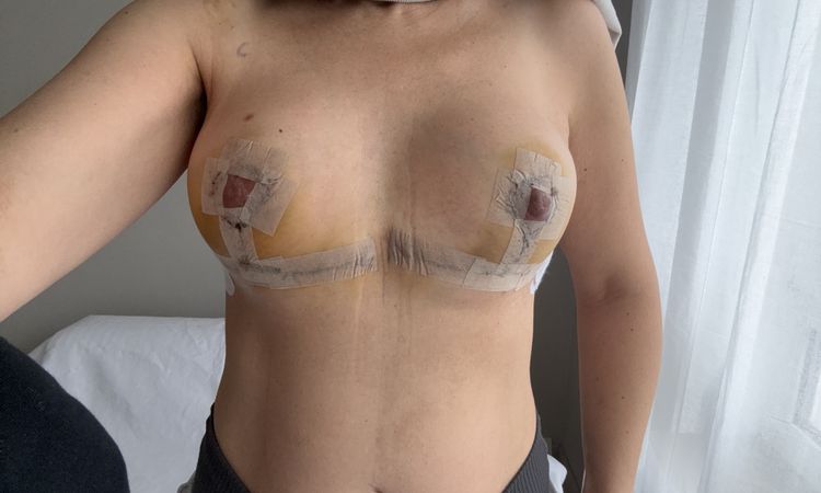 Wie wird sich die Brust nach der Brustverkleinerung entwickeln? - 80354