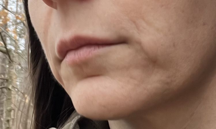 Facelift im unteren Gesichtsbereich möglich? - 80493