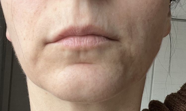 Facelift im unteren Gesichtsbereich möglich? - 80494