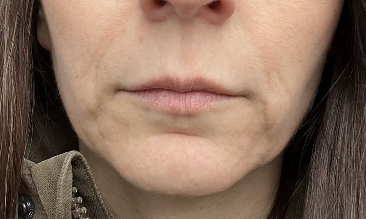 Facelift im unteren Gesichtsbereich möglich? - 80495