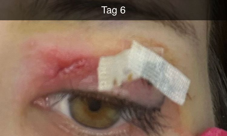 Probleme mit resorbierbaren Fäden Oberliedstraffung - 80583