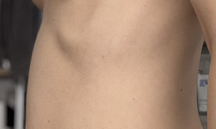 Tröpfchenförmige Implantate 180CC - 80624