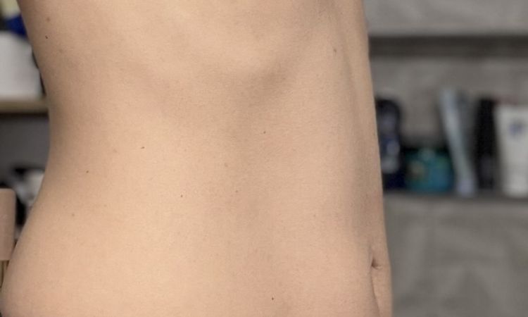 Tröpfchenförmige Implantate 180CC - 80625